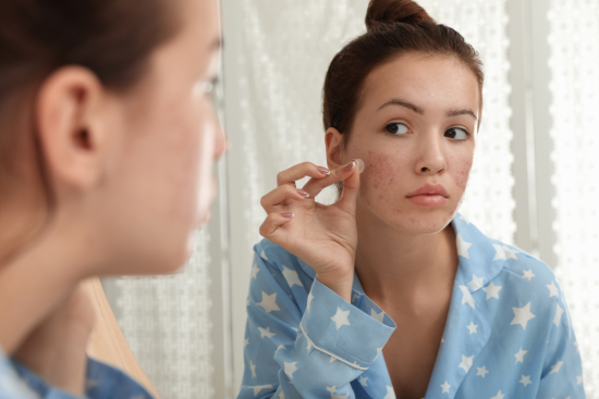 A young woman applying skincare treatment to her acne-prone skin while looking in the mirror.